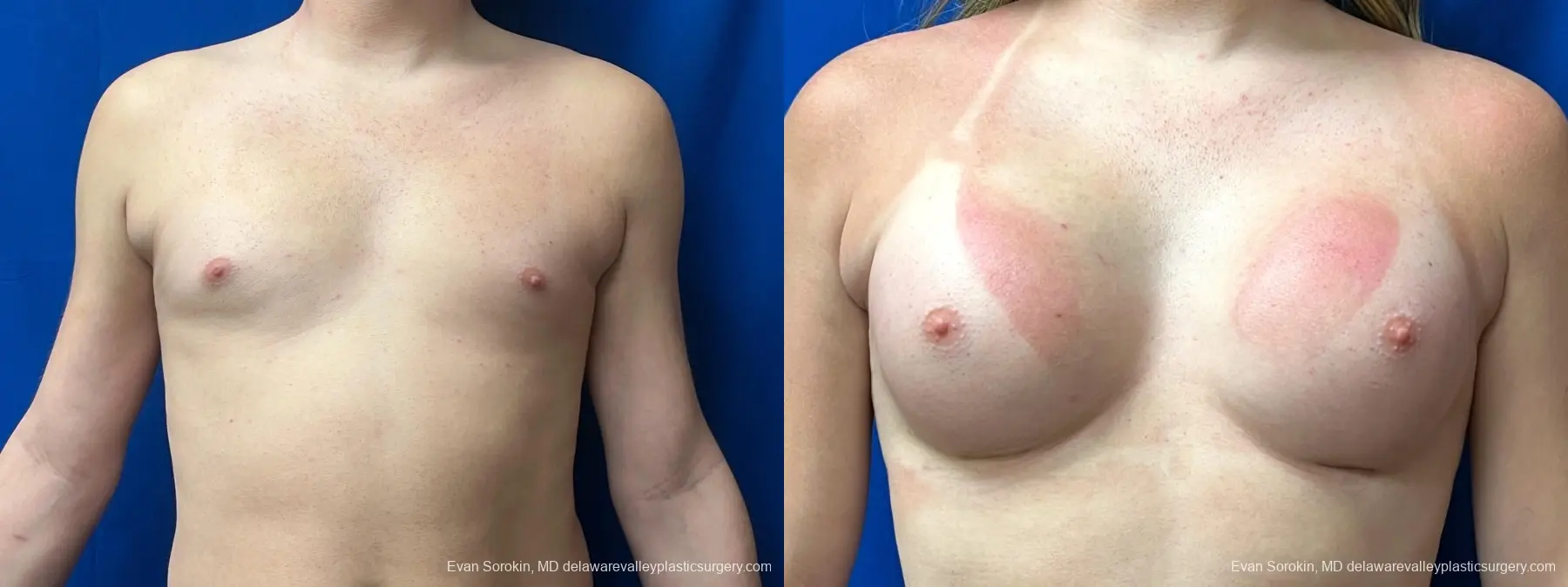 Breast Augmentation: Patient 268 - Before and After 1