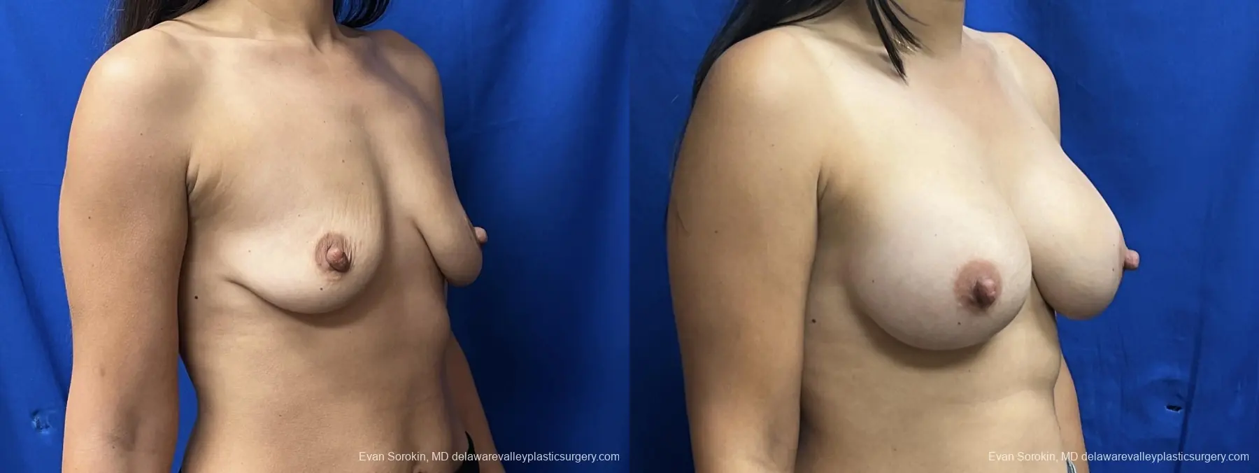 Breast Augmentation: Patient 221 - Before and After 2