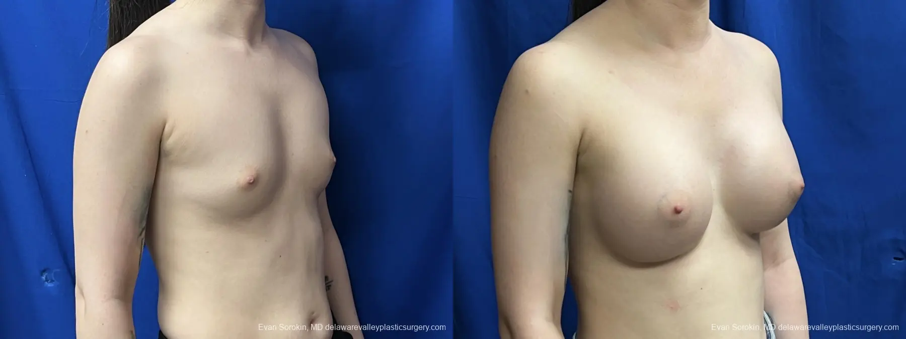 Breast Augmentation: Patient 269 - Before and After 2