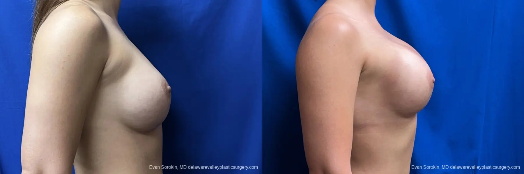 Breast Augmentation: Patient 276 - Before and After 3