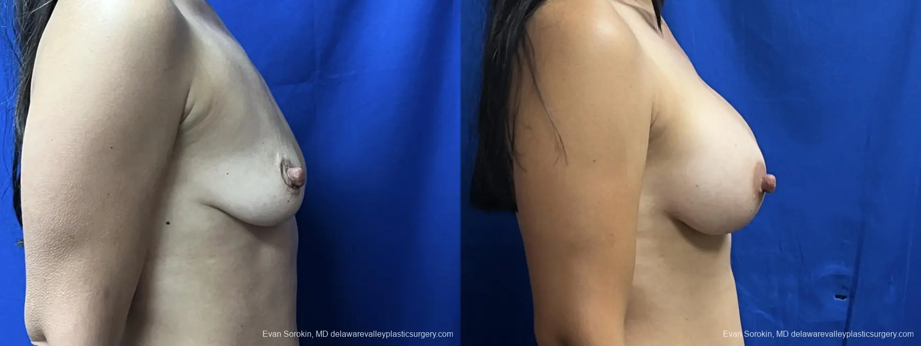 Breast Augmentation: Patient 221 - Before and After 3