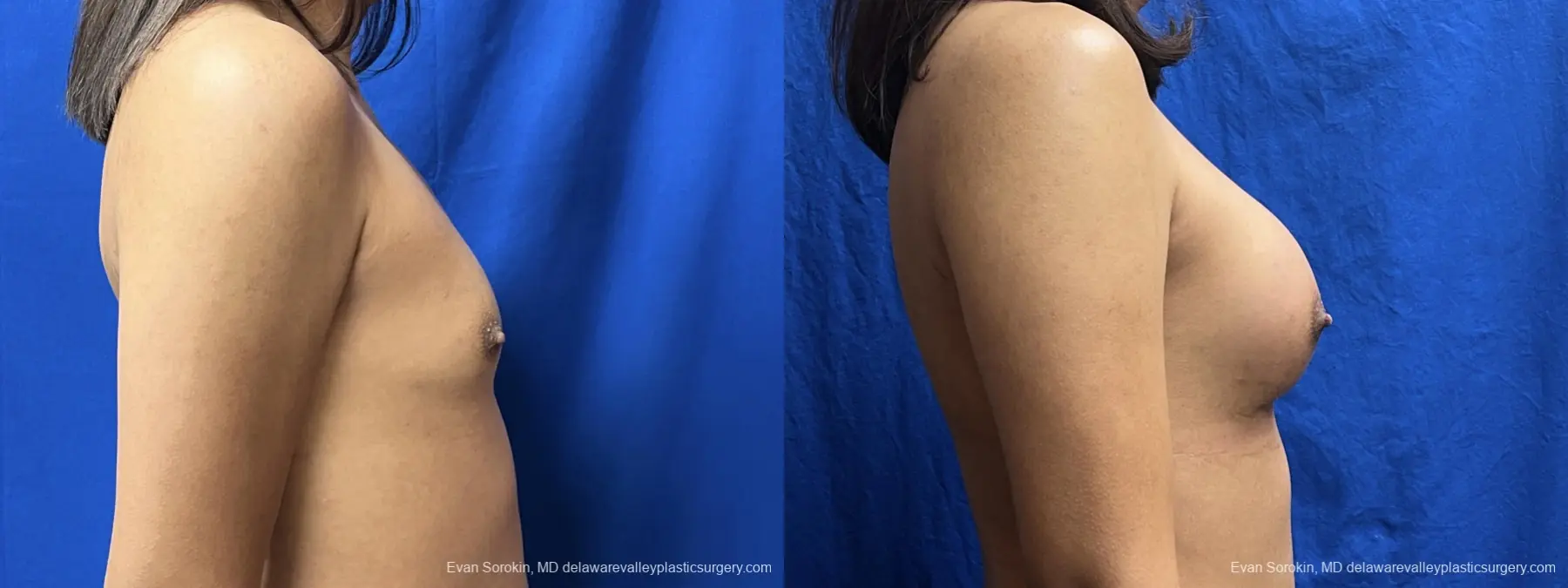 Breast Augmentation: Patient 271 - Before and After 3