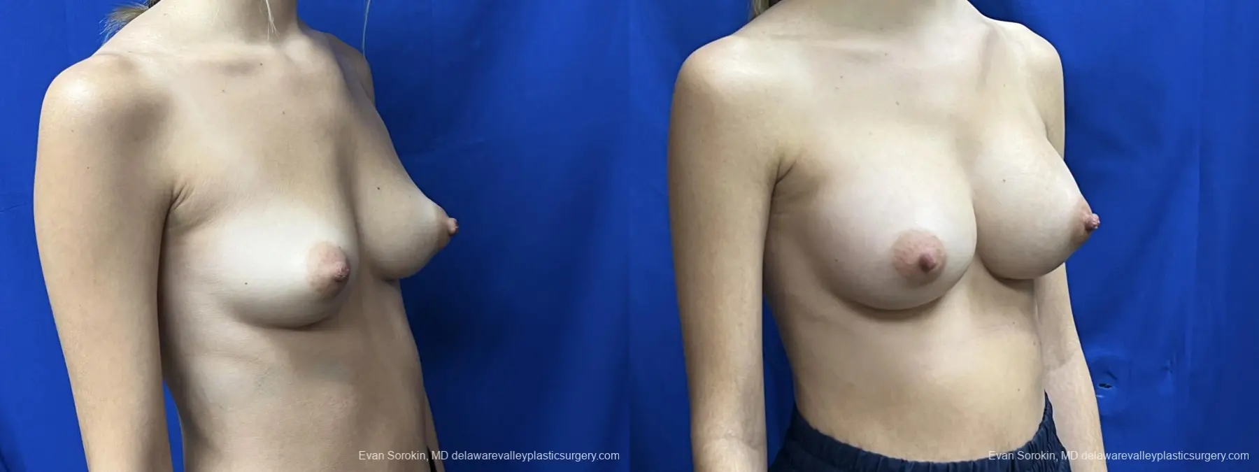 Breast Augmentation: Patient 223 - Before and After 2