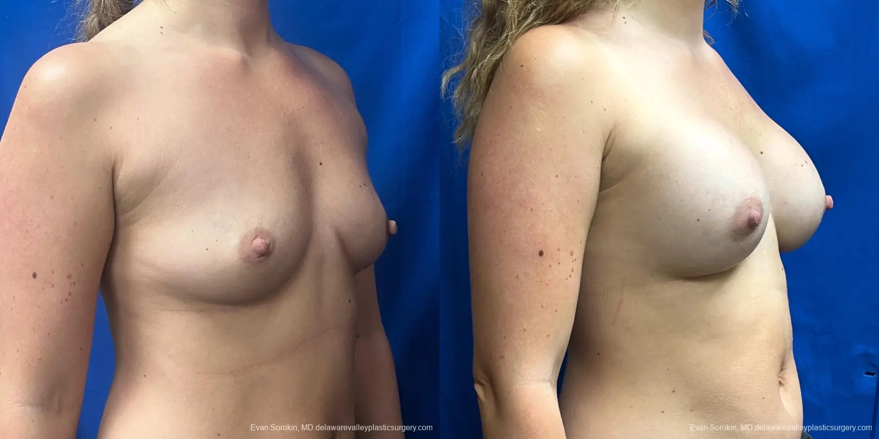 Breast Augmentation: Patient 272 - Before and After 2