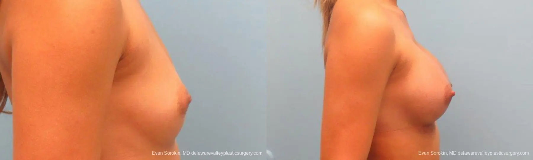 Philadelphia Breast Augmentation 9341 - Before and After 3