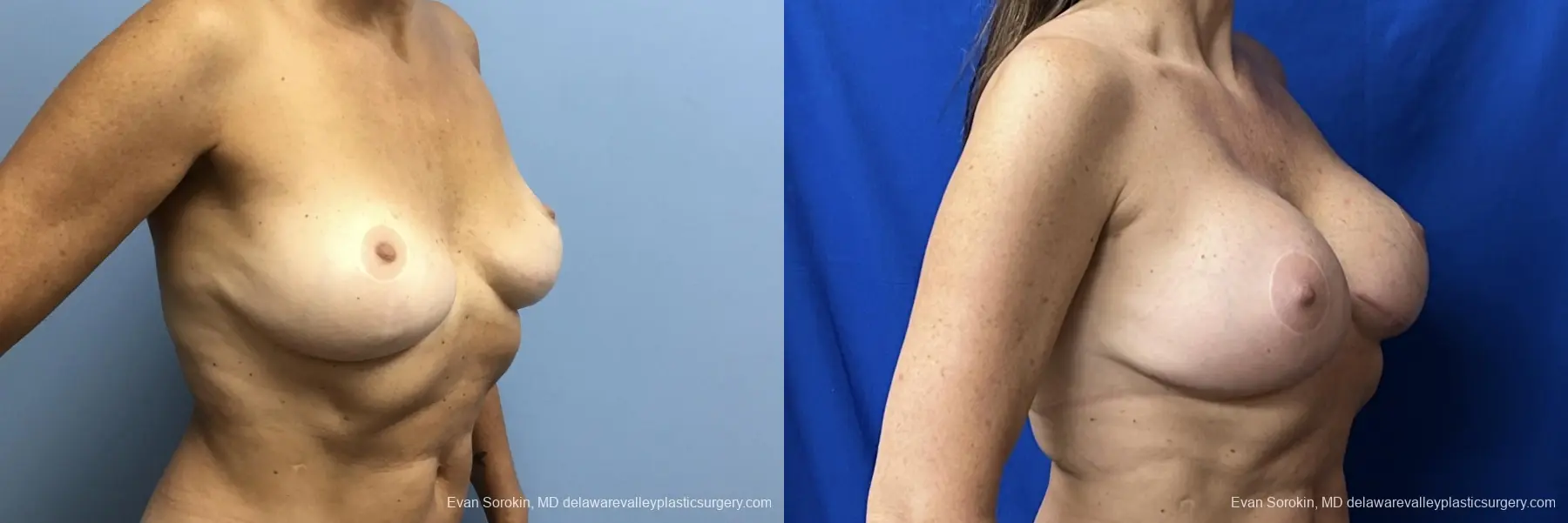 Breast Augmentation: Patient 275 - Before and After 2