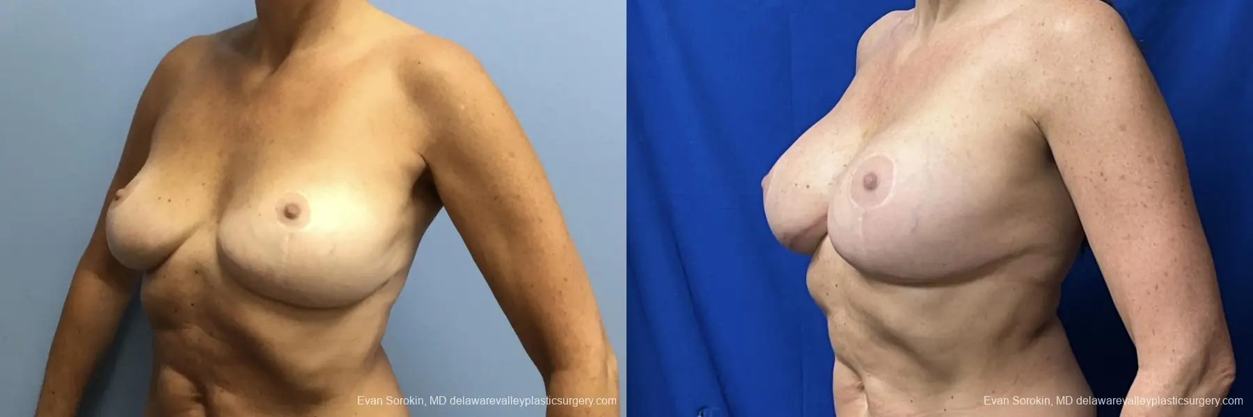 Breast Augmentation: Patient 275 - Before and After 4