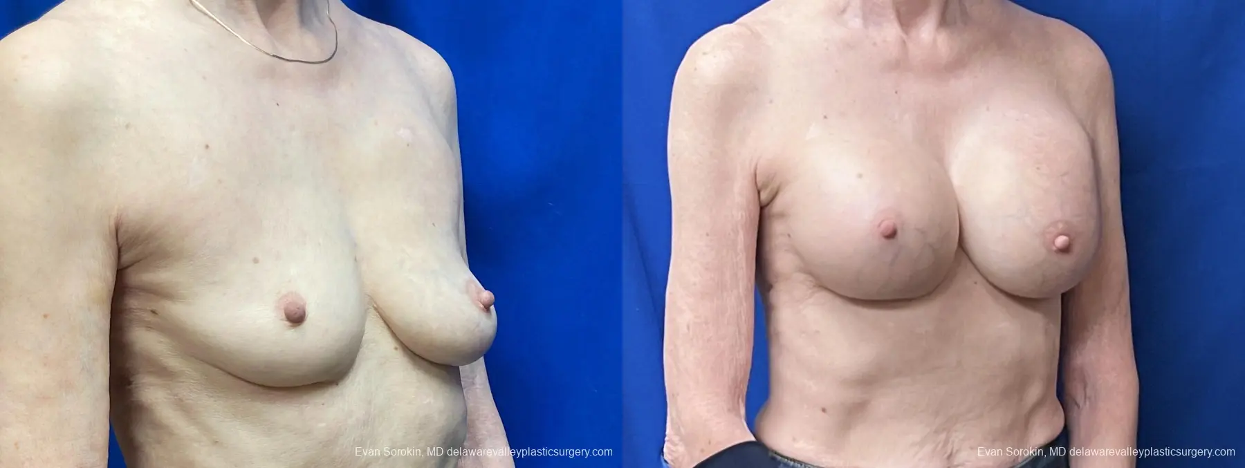 Breast Augmentation: Patient 264 - Before and After 2