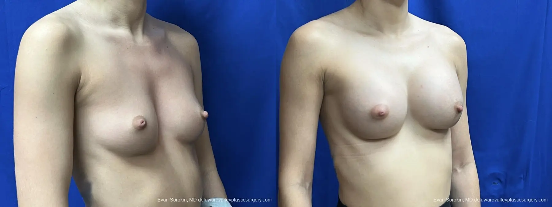 Breast Augmentation: Patient 263 - Before and After 2