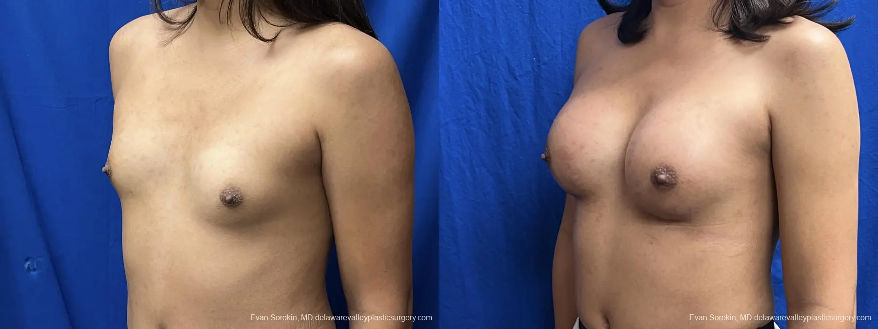 Breast Augmentation: Patient 271 - Before and After 4