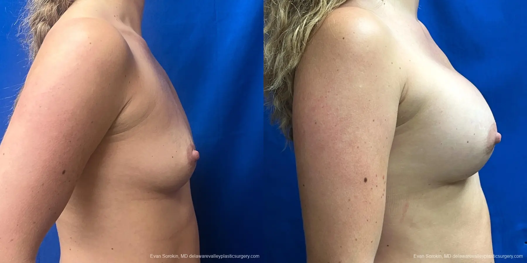 Breast Augmentation: Patient 272 - Before and After 3