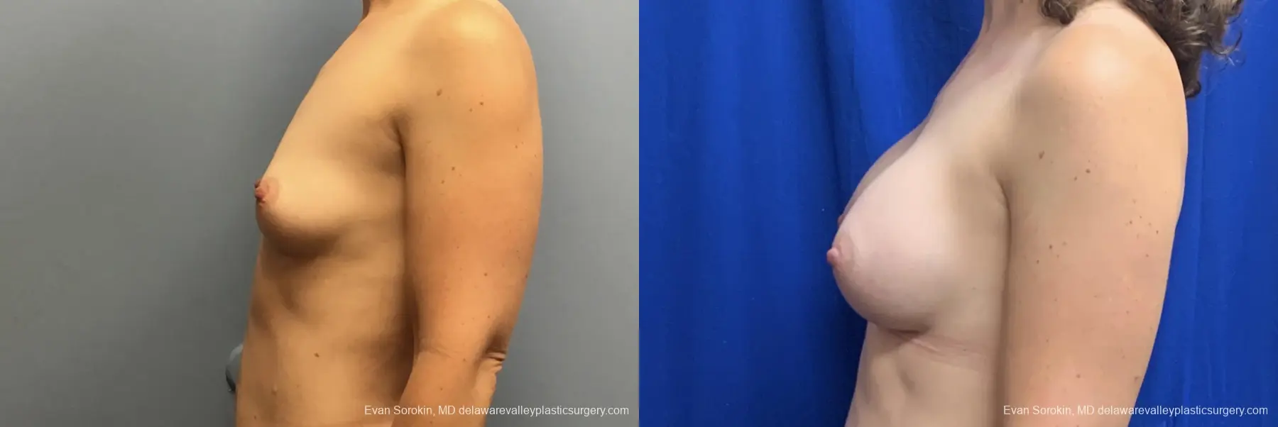 Breast Augmentation: Patient 270 - Before and After 5