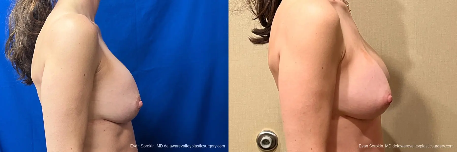 Breast Augmentation: Patient 46 - Before and After 3