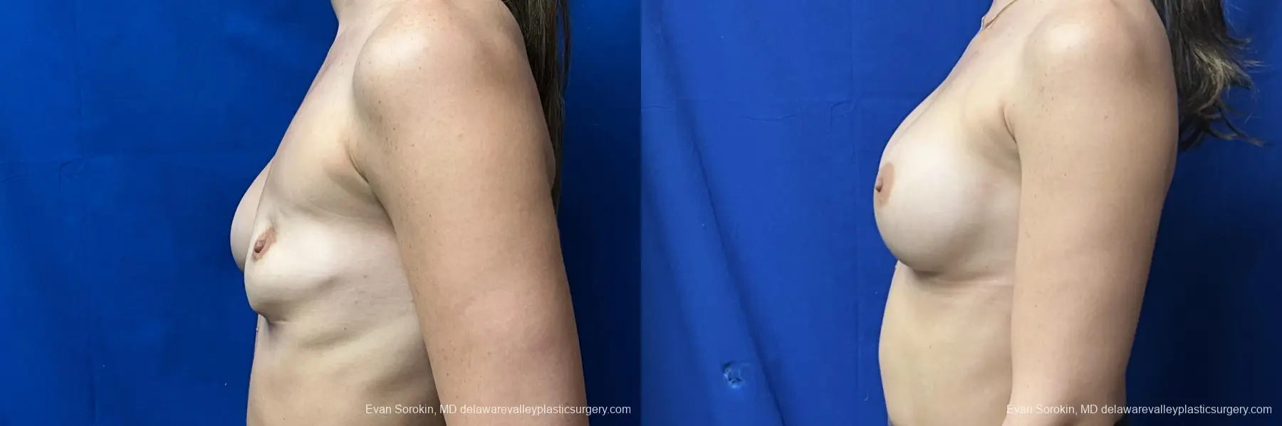 Breast Augmentation: Patient 273 - Before and After 3