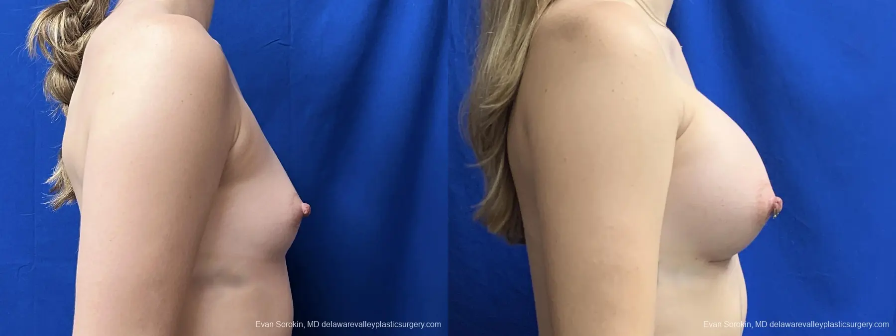 Breast Augmentation: Patient 10 - Before and After 3