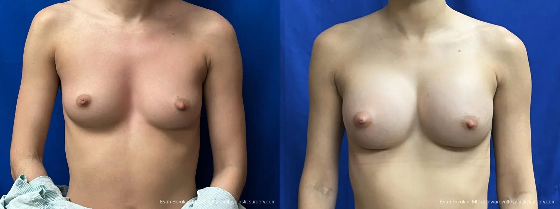 Breast Augmentation: Patient 263 - Before and After 1