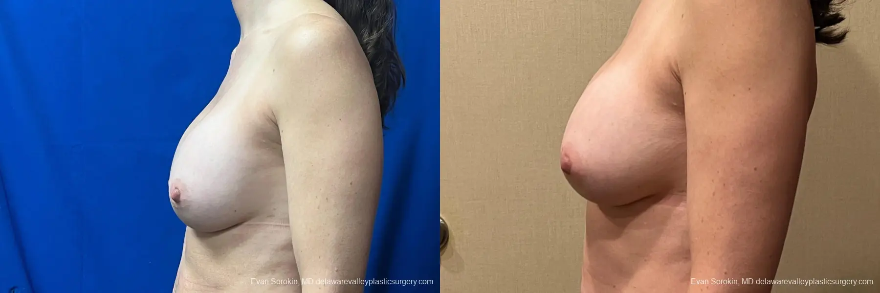 Breast Augmentation: Patient 46 - Before and After 5