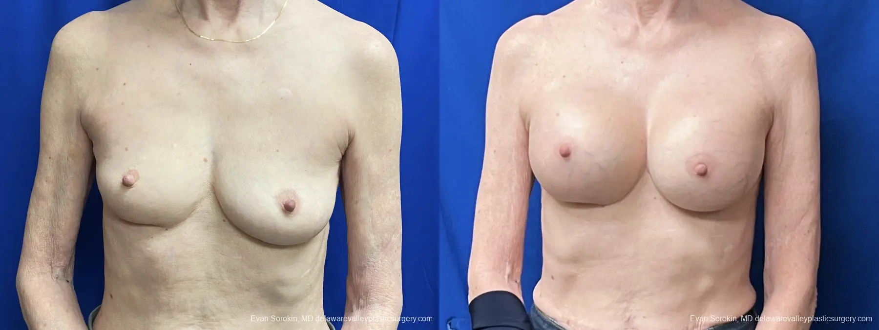 Breast Augmentation: Patient 264 - Before and After 1