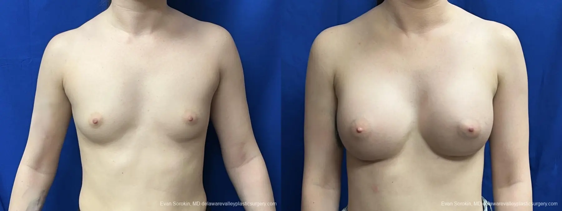 Breast Augmentation: Patient 269 - Before and After 1