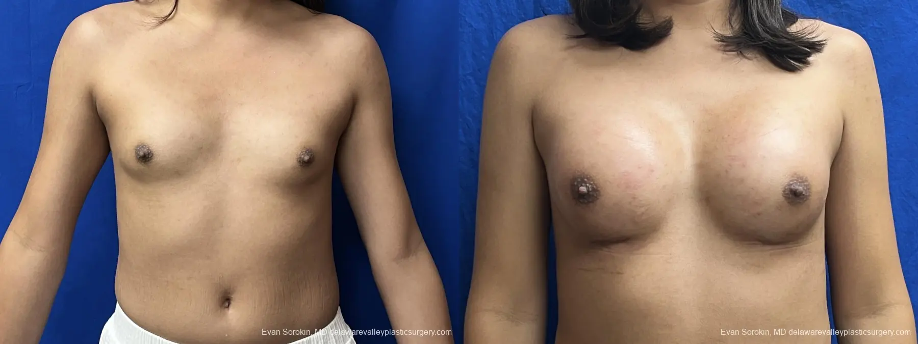 Breast Augmentation: Patient 271 - Before and After 1