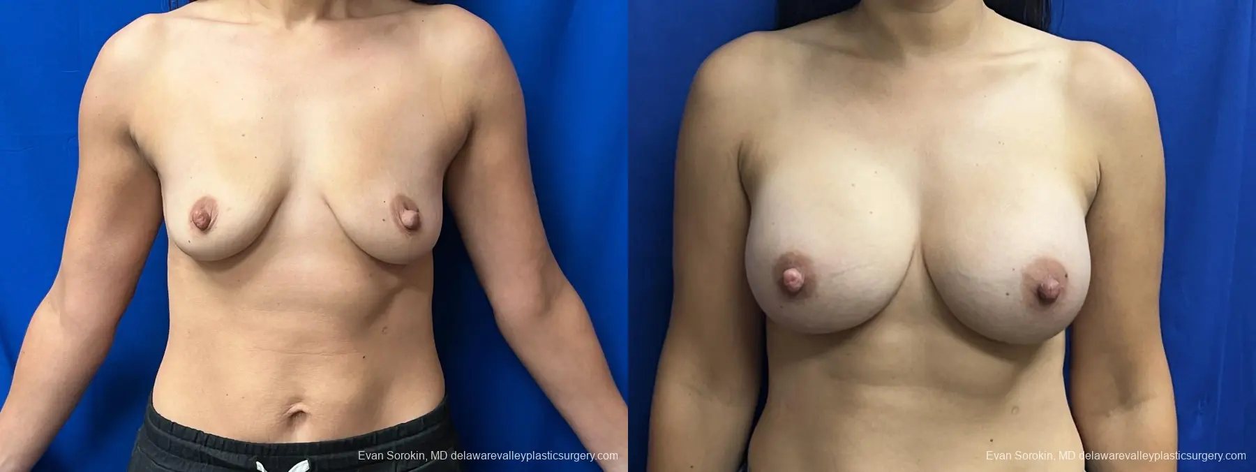 Breast Augmentation: Patient 221 - Before and After 1