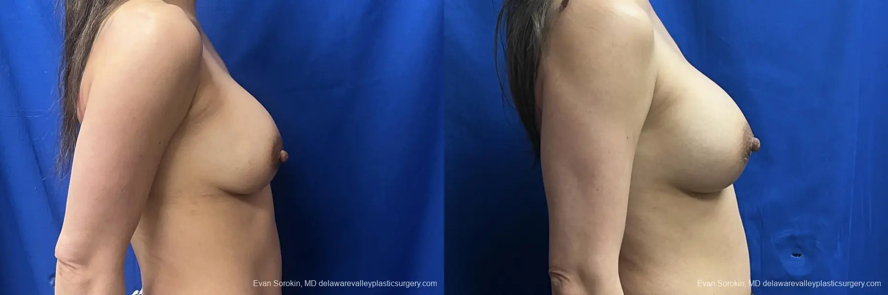 Breast Augmentation: Patient 31 - Before and After 3