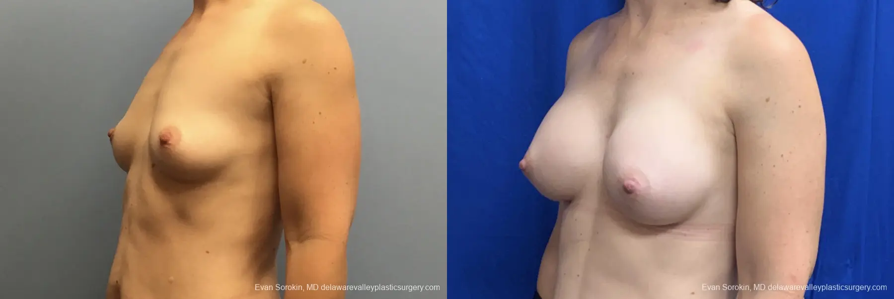 Breast Augmentation: Patient 270 - Before and After 4