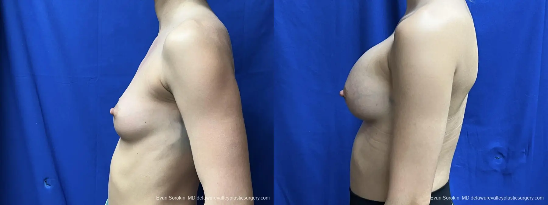 Breast Augmentation: Patient 263 - Before and After 5