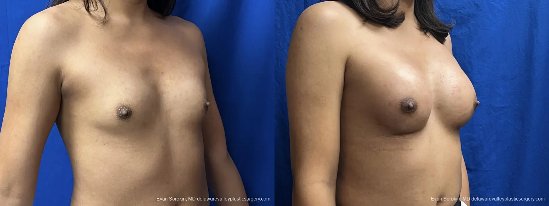 Breast Augmentation: Patient 271 - Before and After 2