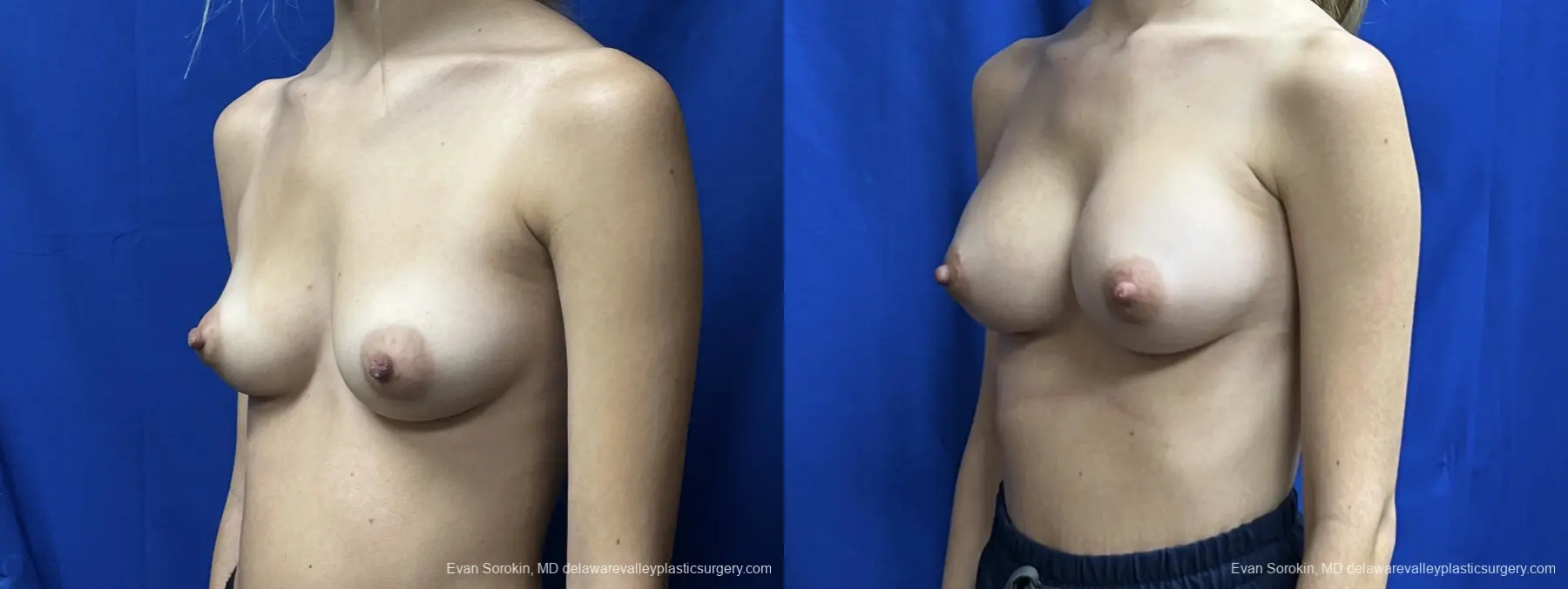 Breast Augmentation: Patient 260 - Before and After 4