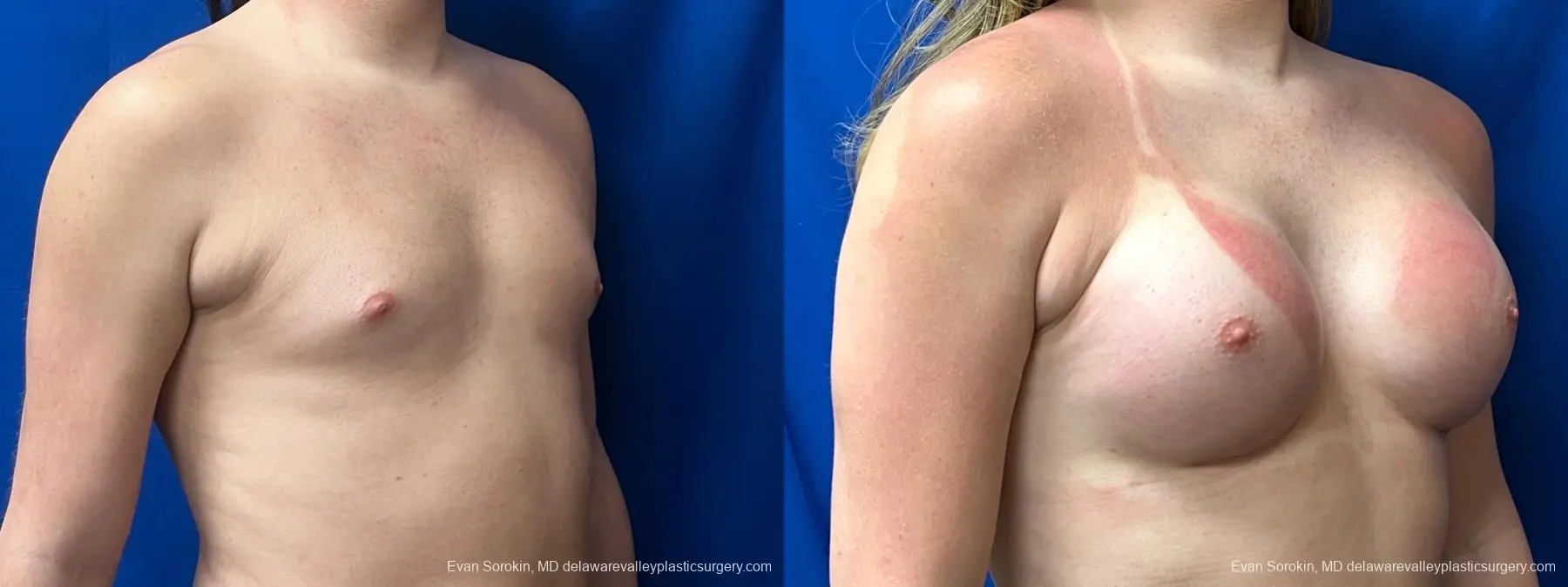 Breast Augmentation: Patient 268 - Before and After 2