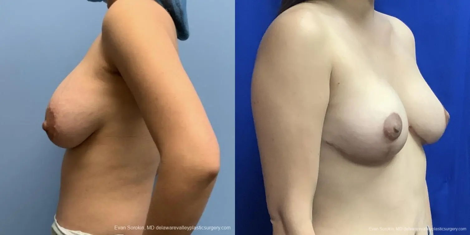 Breast Augmentation: Patient 196 - Before and After 2