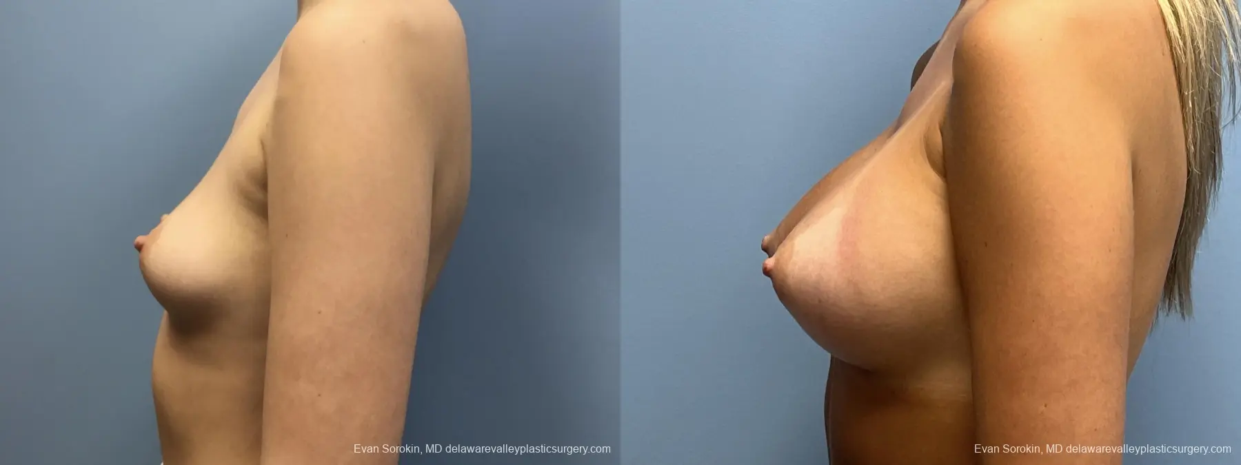 Breast Augmentation: Patient 257 - Before and After 5