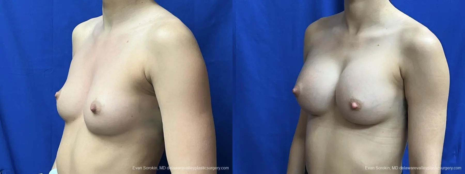 Breast Augmentation: Patient 263 - Before and After 4