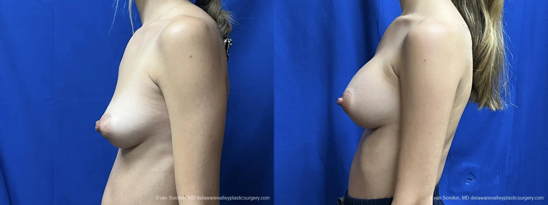 Breast Augmentation: Patient 260 - Before and After 5