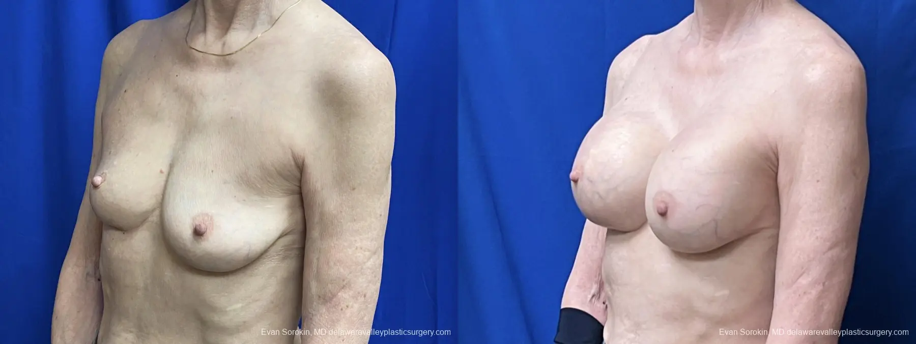 Breast Augmentation: Patient 264 - Before and After 3