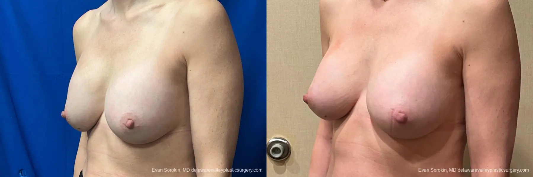 Breast Augmentation: Patient 46 - Before and After 4