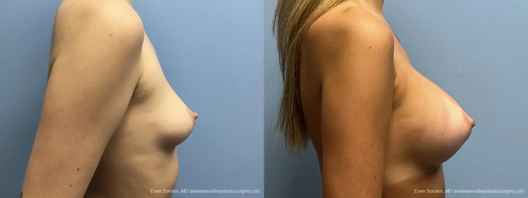 Breast Augmentation: Patient 257 - Before and After 3