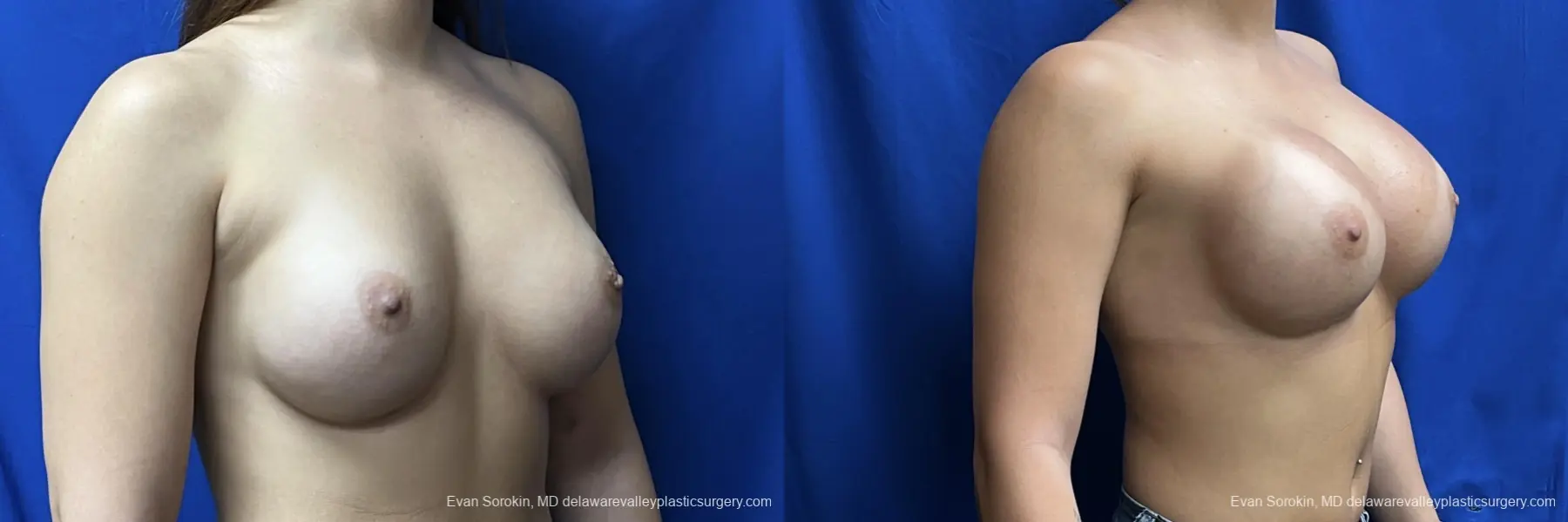 Breast Augmentation: Patient 276 - Before and After 2