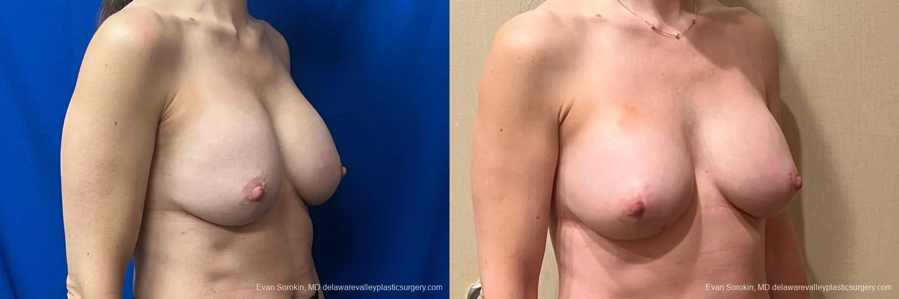 Breast Augmentation: Patient 46 - Before and After 2