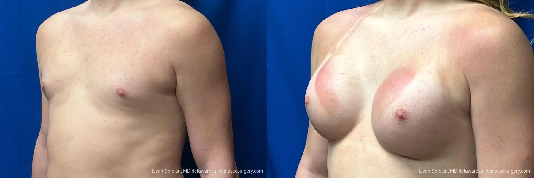 Breast Augmentation: Patient 268 - Before and After 4