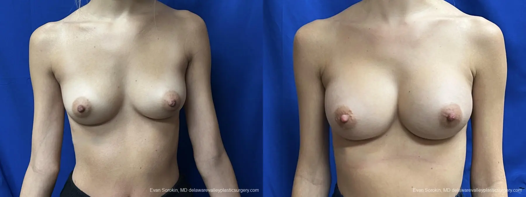 Breast Augmentation: Patient 260 - Before and After 1