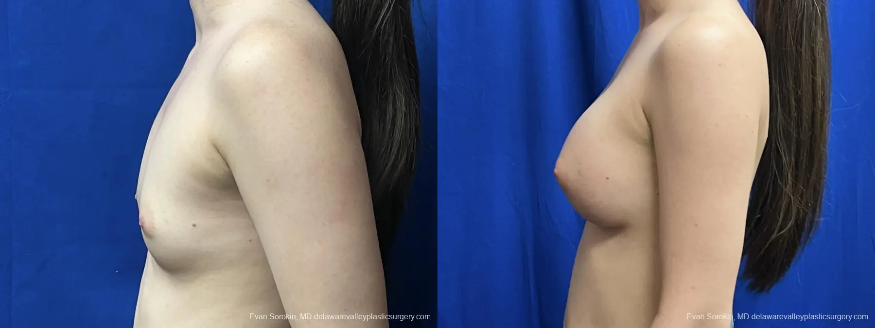 Breast Augmentation: Patient 269 - Before and After 5