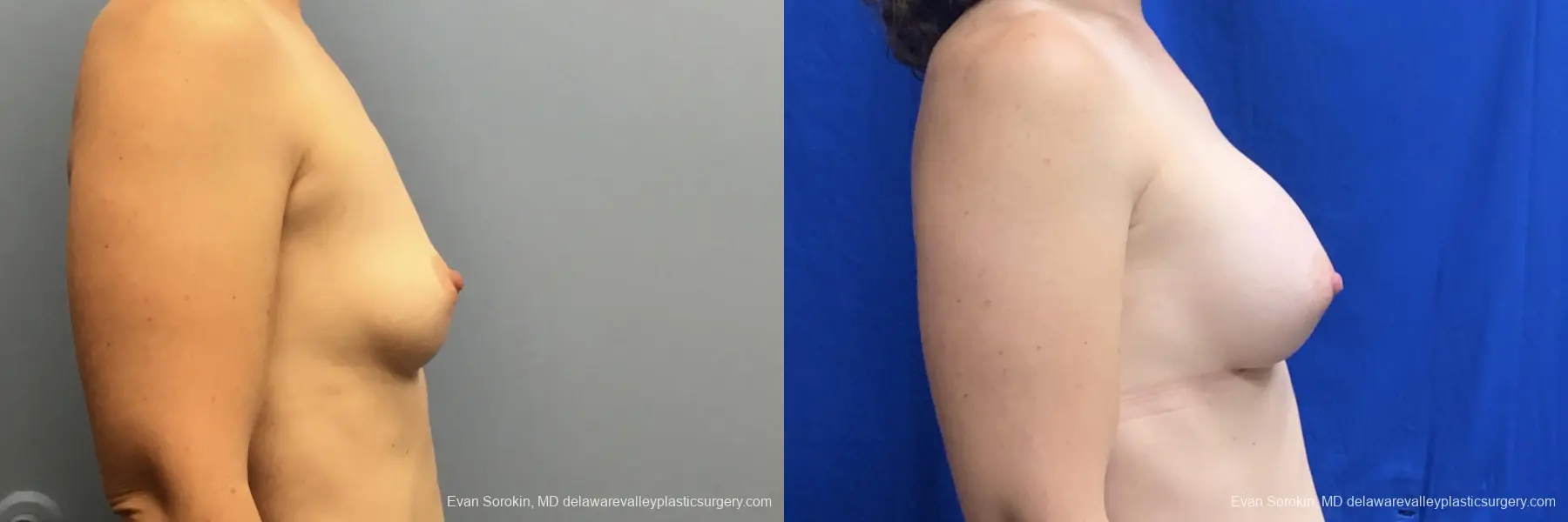 Breast Augmentation: Patient 270 - Before and After 3