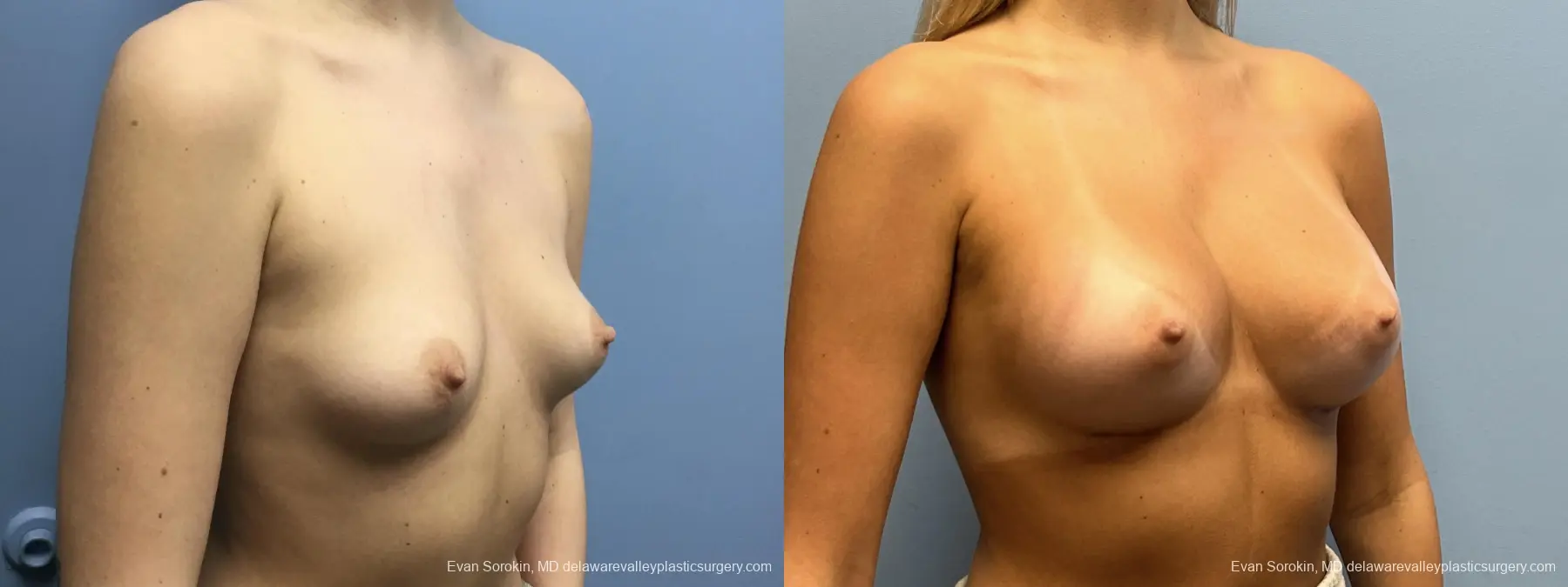 Breast Augmentation: Patient 257 - Before and After 2