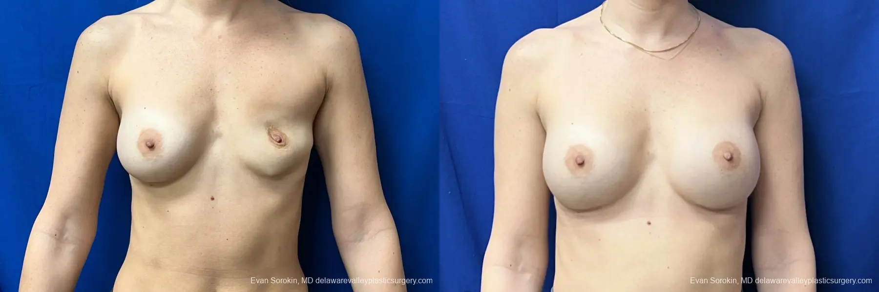 Breast Augmentation: Patient 273 - Before and After 1