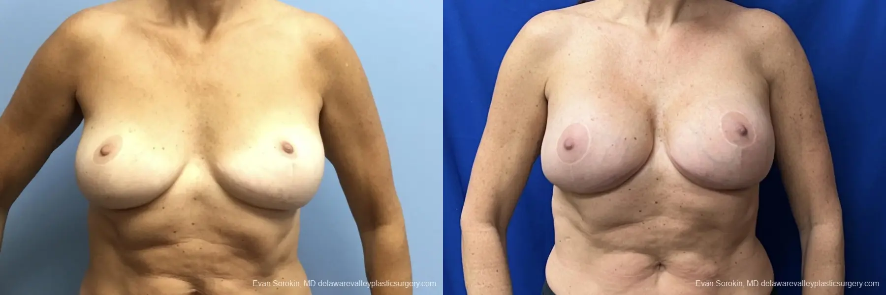 Breast Augmentation: Patient 275 - Before and After 1