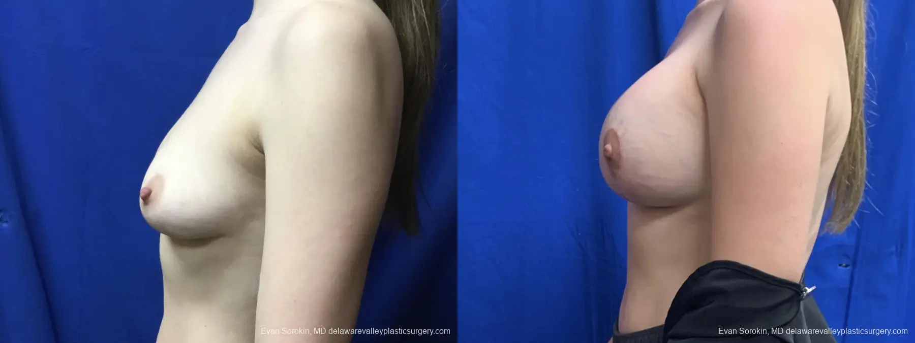 Breast Lift And Augmentation: Patient 3 - Before and After 5