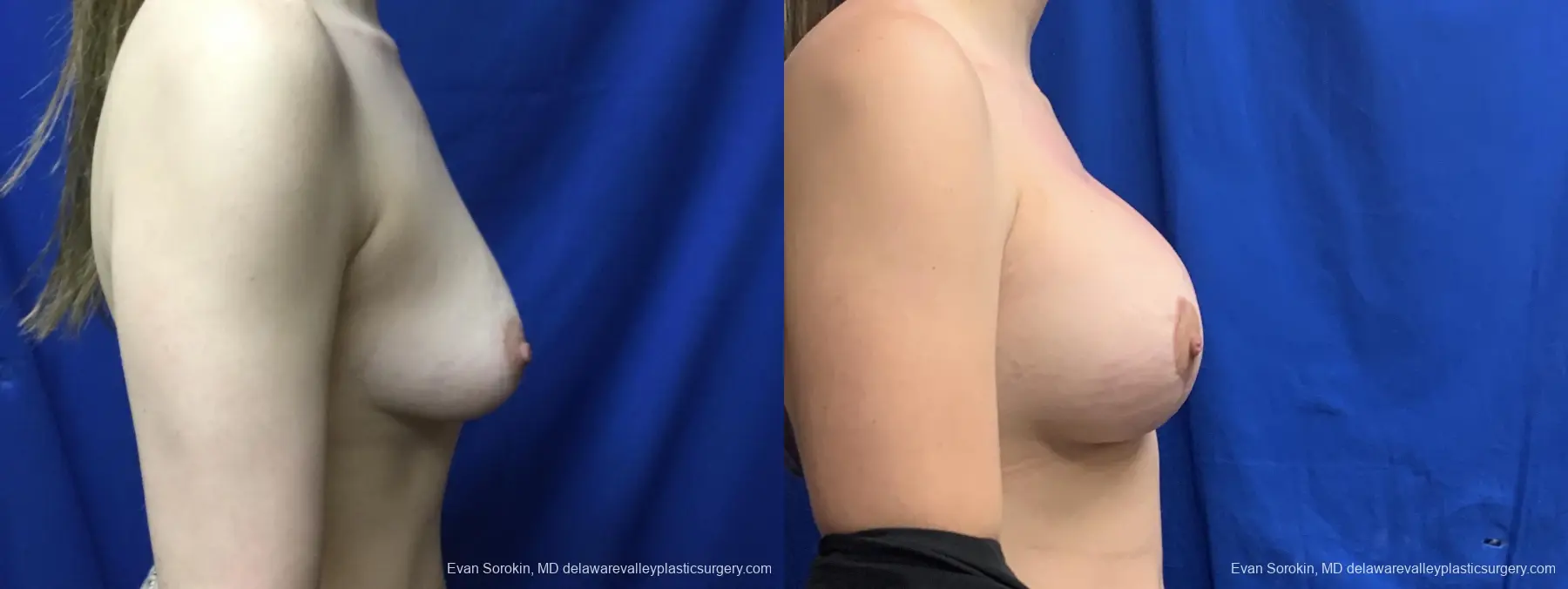 Breast Lift And Augmentation: Patient 3 - Before and After 3