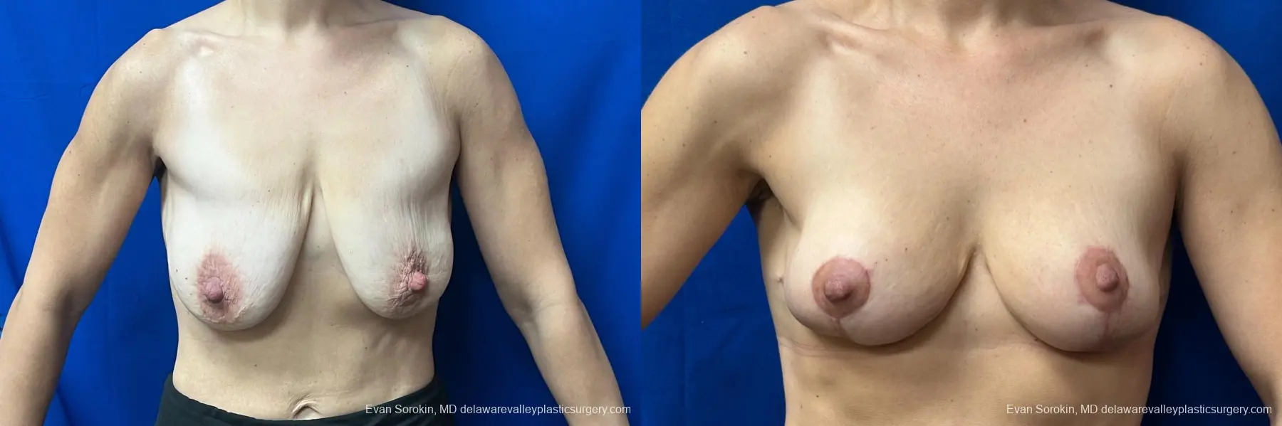 Breast Lift: Patient 2 - Before and After 1